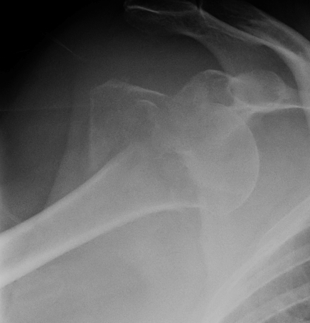 Shoulder Dislocation Greater Tuberosity Fracture